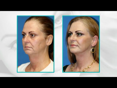 Facial Plastic Surgery Before and After :15 Years Younger (Facelift, facial fat transfer, eyelid)