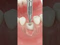 Single Tooth Implant 🦷 | Complete 3D Journey Explained in Seconds!