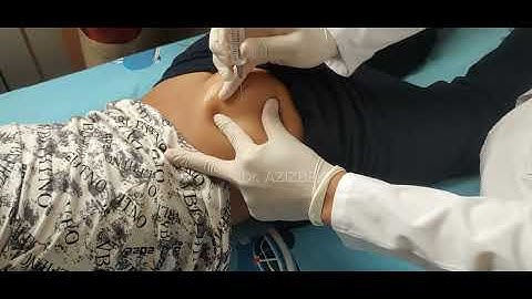 intramuscular injection into the gluteal muscle #doctor #intramuscularinjection #injection