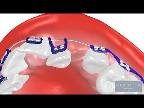 Oque é Ortodontia? Como funciona um Aparelho Ortodôntico?