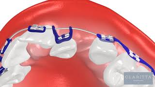 Oque  Ortodontia Como Funciona Um Aparelho Ortodntico ortodontia invisalign clinicajin