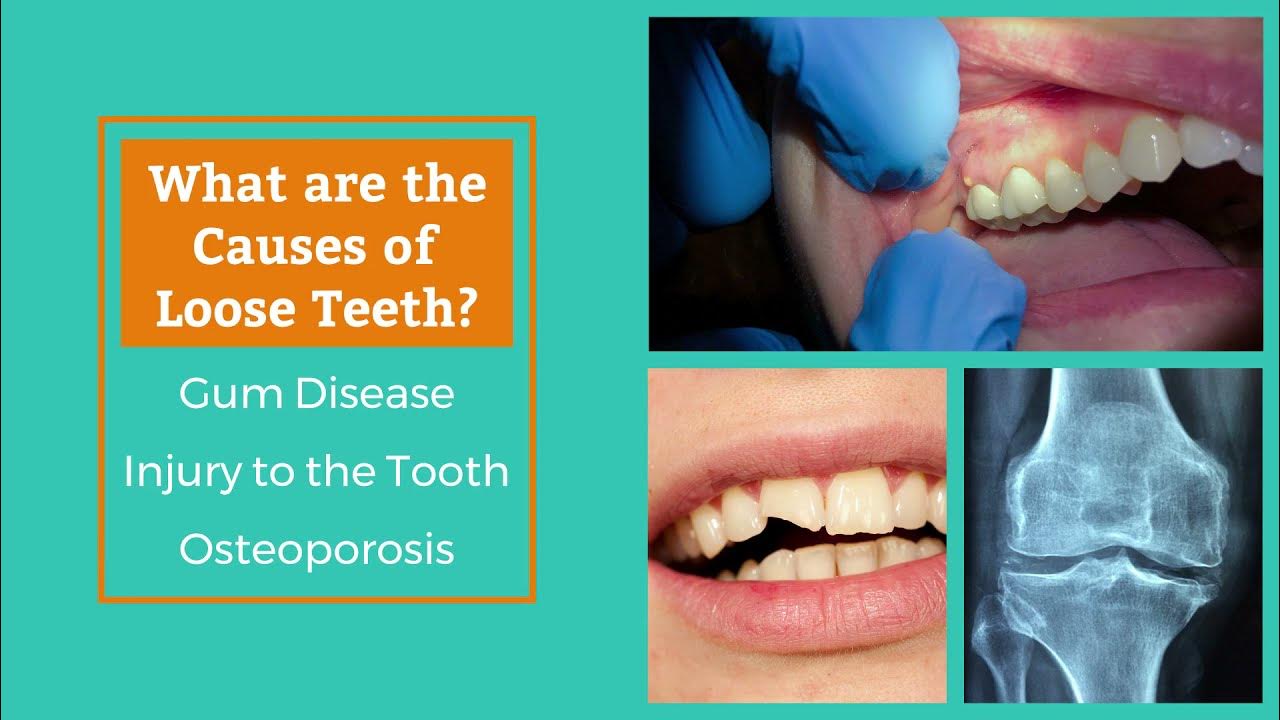 How to Fix Your Loose Teeth YouTube