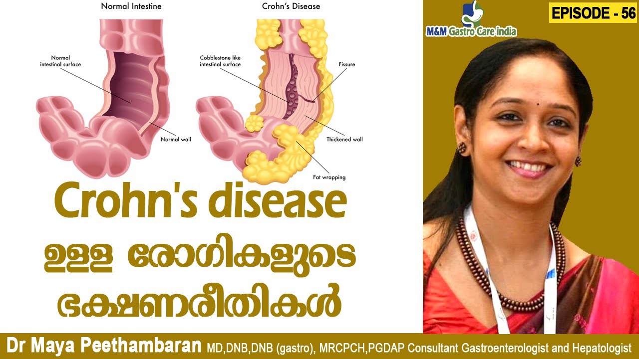 Crohn's disease ഉള്ള രോഗികളുടെ ഭക്ഷണരീതികൾ | M&M Gastro Care India