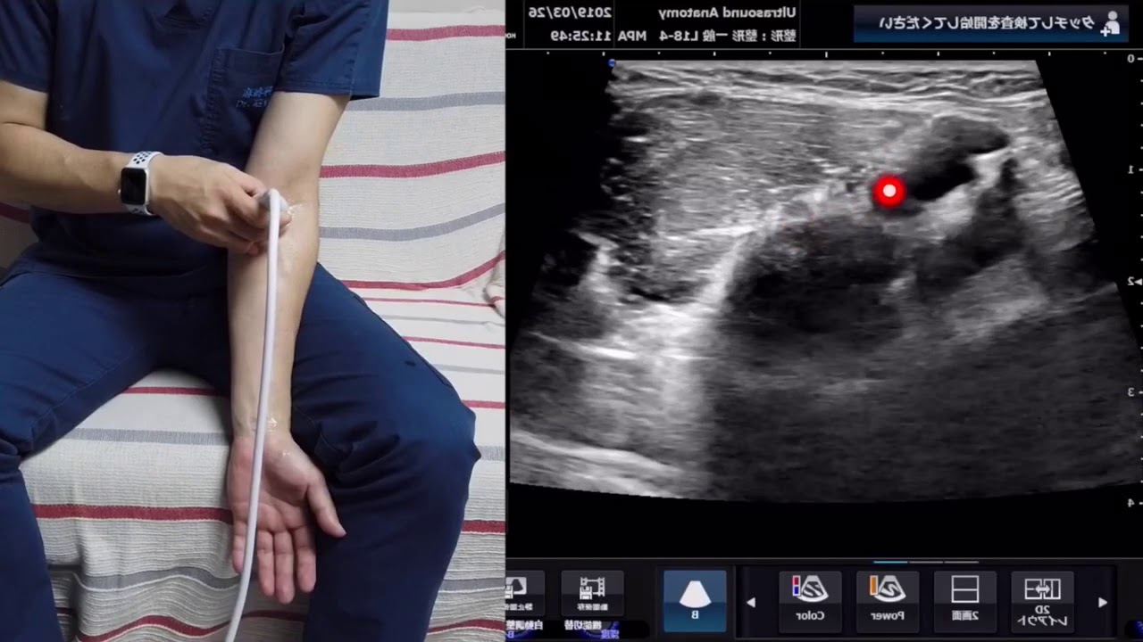 前腕の正中神経　overview