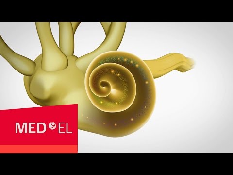 Sensorineural Hearing Loss Occurs in the Cochlea | MED-EL