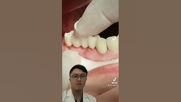 Cận cảnh gắn răng sứ!!! #drcongcam #rangsu #implant