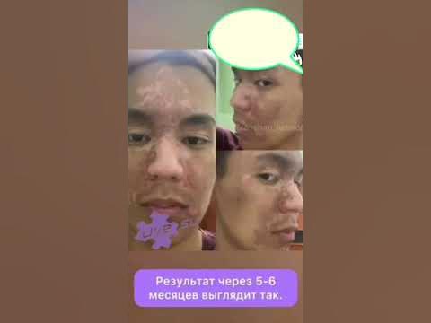 витилигадан ем жапондык онимдер керемет натиже - YouTube