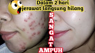 MENGHILANGKAN JERAWAT CEPAT | CREAM DR PURE