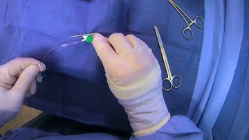 Closing AV Graft/Fistula Access Sites (Purse String And Toggle Technique)