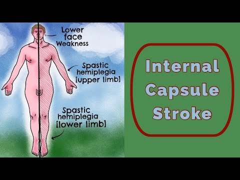 Internal Capsule Stroke