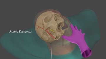 Percutaneous Balloon rhizotomy Animation