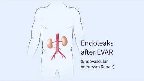 Endoleaks after Endovascular Repair of Thoracic Aortic Aneurysms (EVAR)