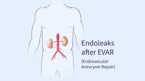 Endoleaks after Endovascular Repair of Thoracic Aortic Aneurysms (EVAR)