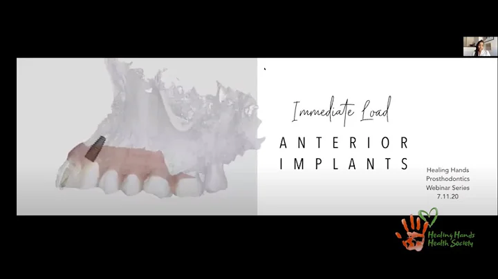 Anterior Load Immediate Implants By Dr Gabrielle J...