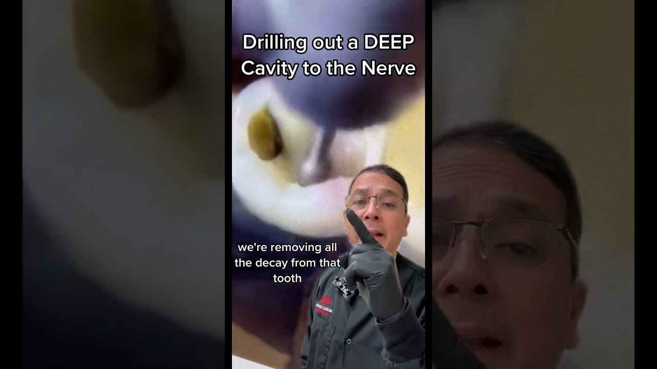 Removing Deep Cavity To Prepare For Root Canal View Mobile Dental