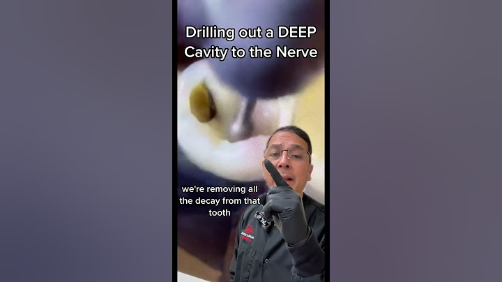Removing Deep Cavity to Prepare for Root Canal | View Mobile Dental