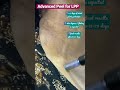 Advanced Peel For LPP I Dr Ashima Goel I Dermatologist In Chandigarh Shorts Advanced Peel For LPP I Dr Ashima Goel I Dermatologist In Chandigarh Shorts