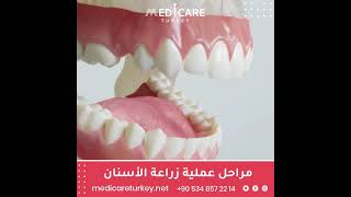 مراحل عملية زراعة الأسنان