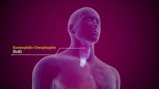 What are Eosinophilic-Associated Diseases (EADs)
