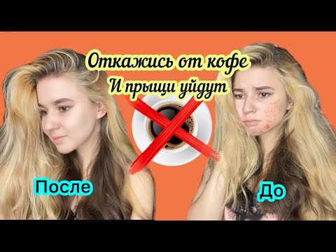 КАК ИЗБАВИТЬСЯ ОТ ПРЫЩЕЙ ? ВСЕ ИЗ-ЗА КОФЕ?