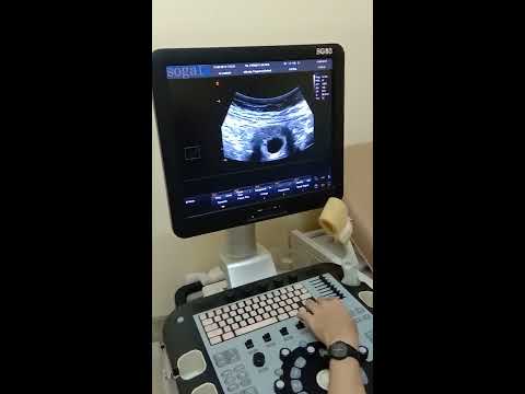 Video: 5 Minggu Kehamilan: Keterangan, Ultrasound, Sensasi