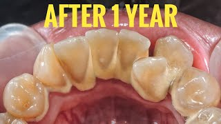 Scaling Dental Cleaning After 1 Year | Tartar | Dentist | Dokter Gigi Ruliyanto