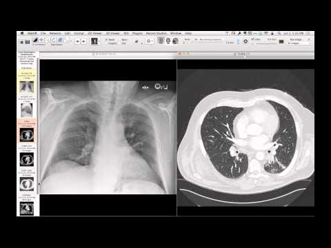 Typical Bronchial Carcinoid