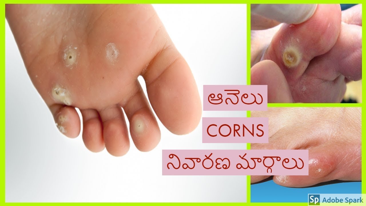 How to Get Rid of Corns ఆనల నవరణ మరగల Corn Treatment