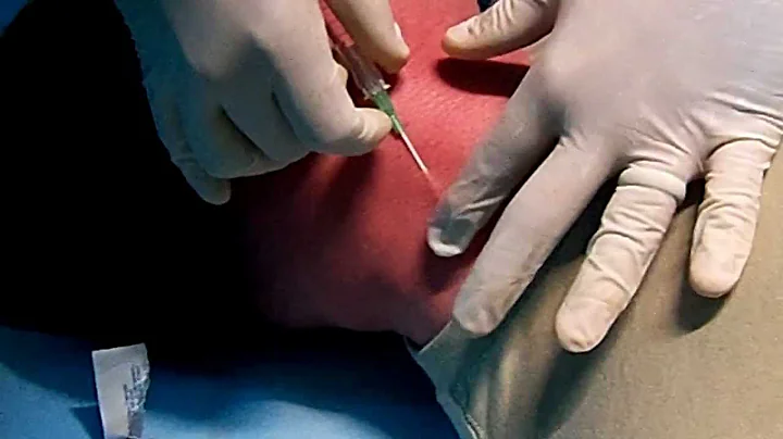 External Jugular IV insertion.