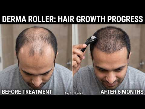 Derma Roller for Baldness: Does It Actually Work?