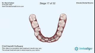 Invisalign Treatment Plan 3