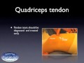 Quadriceps Tendon Tear