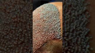 5550 Follicular Unit Extraction! 💉#transplantsurgery #hairtransplant #hairtransformation #fyp