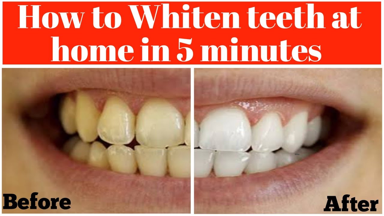 How to get whiten teeth at home in 5 mintsGet white teeth instantly