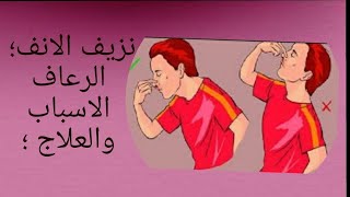 الرعاف( نزيف الانف) الاسباب والعلاج بطرق طبيعية ..