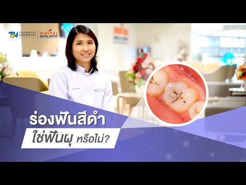 ร่องฟันสีดำ ใช่ฟันผุหรือไม่ | 𝐃𝐢𝐠𝐢𝐭𝐚𝐥 𝐃𝐞𝐧𝐭𝐚𝐥 𝐂𝐞𝐧𝐭𝐞𝐫