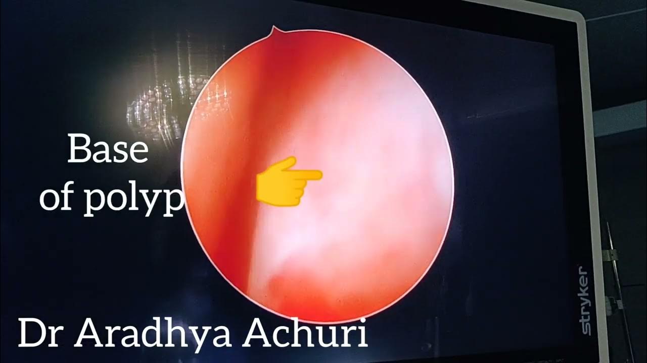 cervical-polyp-removal-hysteroscopic-polypectomy-polypterus
