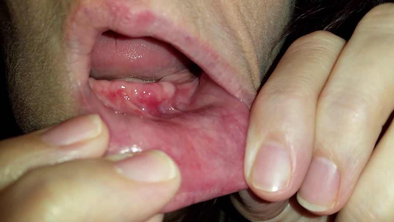 Lots Of Bone Fragments Popping Out Major Pain Brain Cancer Youtube