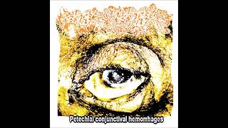 Putrefied - 'Petechial Conjunctival Hemorrhage' (EP 2024)