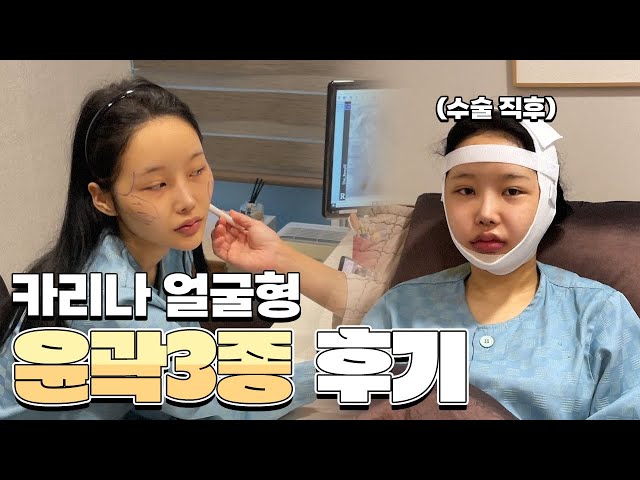 카리나 얼굴형, 윤곽3종 수술전 영상 공개💕