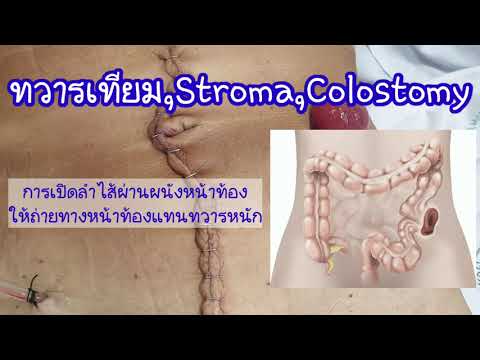 ทวารเทียม Stroma Colostomy  ep.1 คืออะไร มีไว้ทำไม จำเป็นยังไง