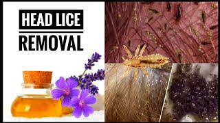 How To Get Rid Of Head Lice Permanently Fastlice Removal