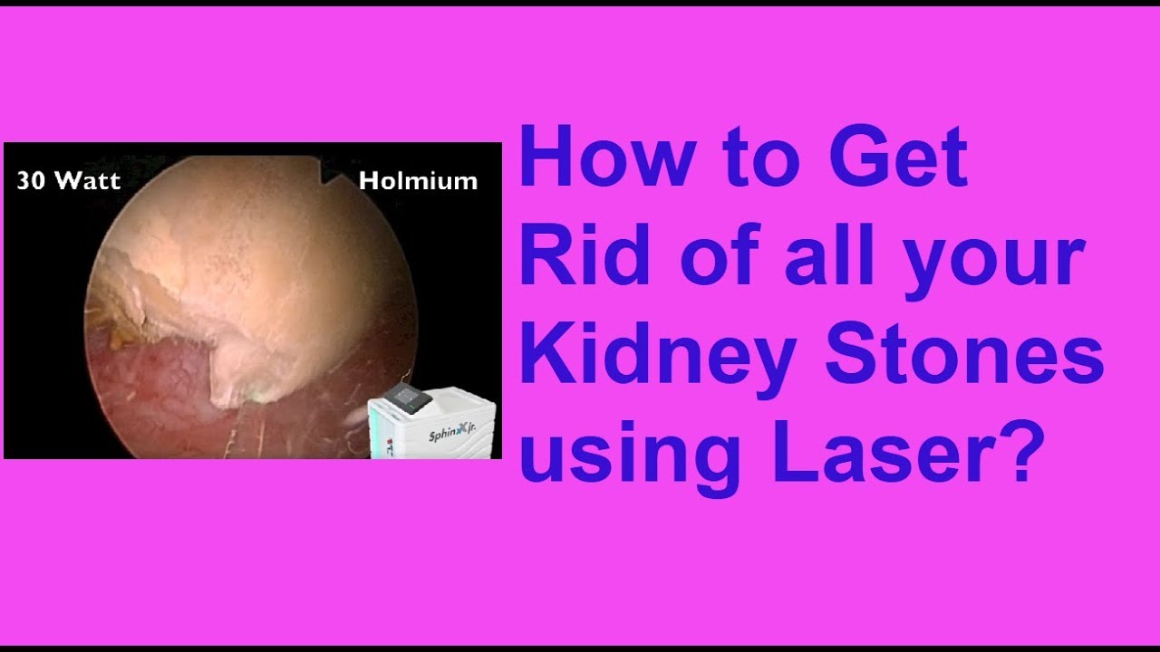 Latest Treatment For Kidney Stones Laser Removal Of Kidney Stone Latest Treatment For Kidney Stones Laser Removal Of Kidney Stone