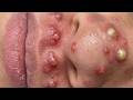 Feel The Extraction Through The Screen | Pimple Popping #800200