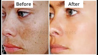 I Promise This Will Remove Your Darkspots Permanently, Say Goodbye to Blackspots, Pigmentation and..