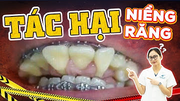 Tác Hại Của Niềng Răng Mà Nha Sĩ Không Nói Cho Bạn Biết: Xem Video Để Cân Nhắc Có Nên Niềng Không!