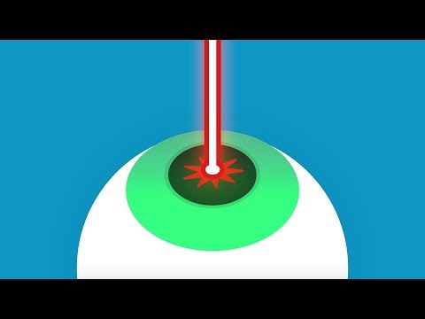 Goopcast #9 - Laser Eye Surgery