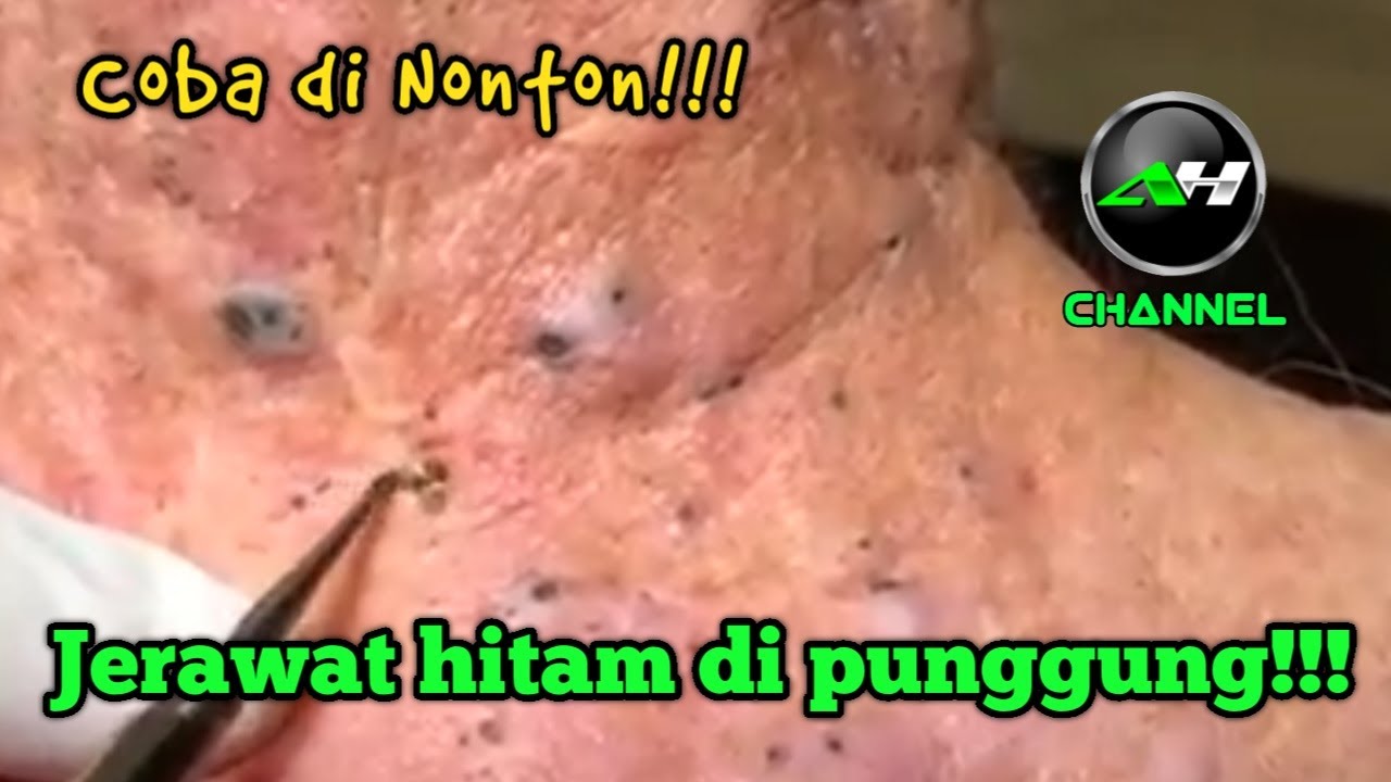 Cara Menghilangkan Parut Hitam Di Badan - CARA HILANGKAN PARUT JERAWAT