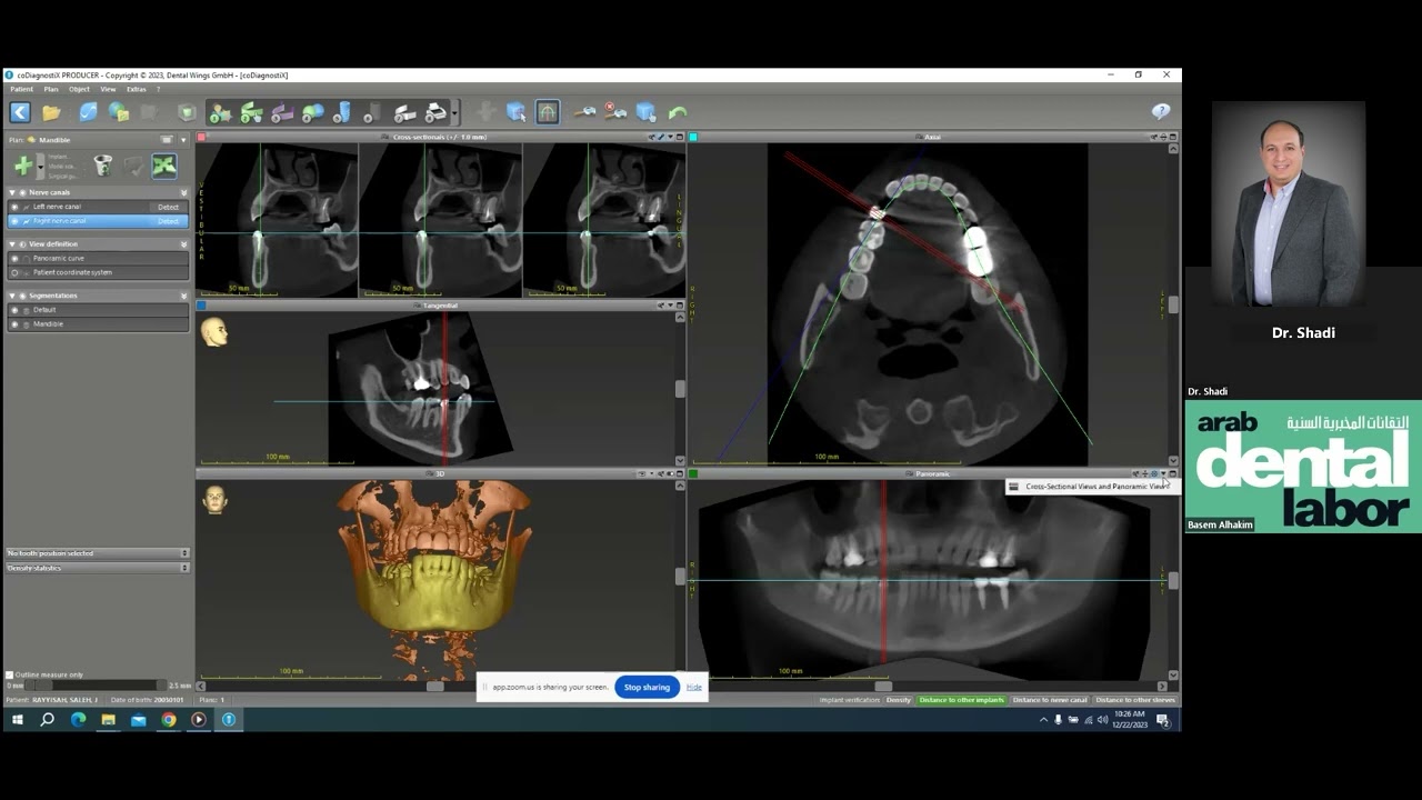 coDiagnostix Implant Surgical guide design  -  Dr Shadi Almoghayer