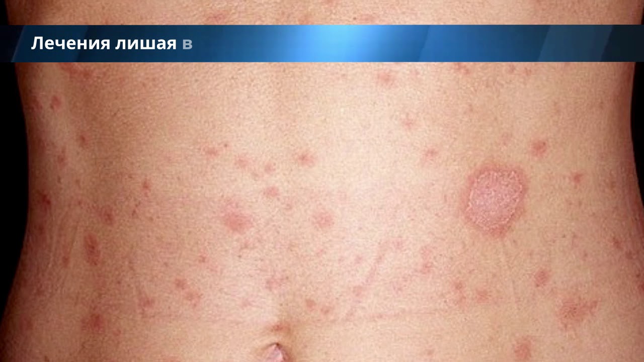 Лечение лишая народными средствами - рецепты, аналоги, профилактика ...